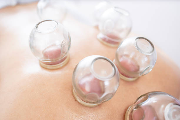 Wet cupping Hijama therapy in Dubai