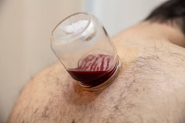 Hijama consultation in Dubai