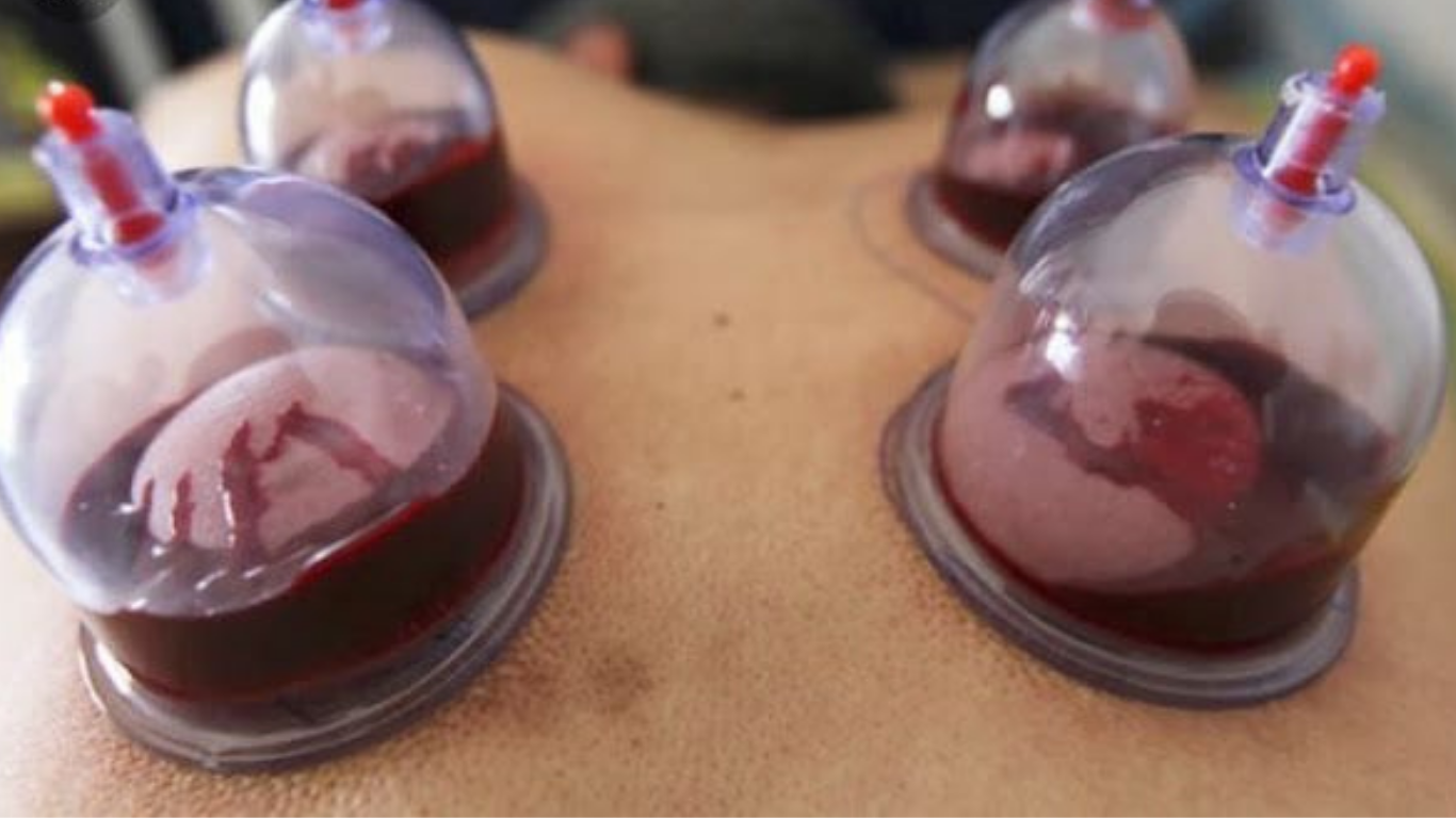 Hijama Cupping Therapy
