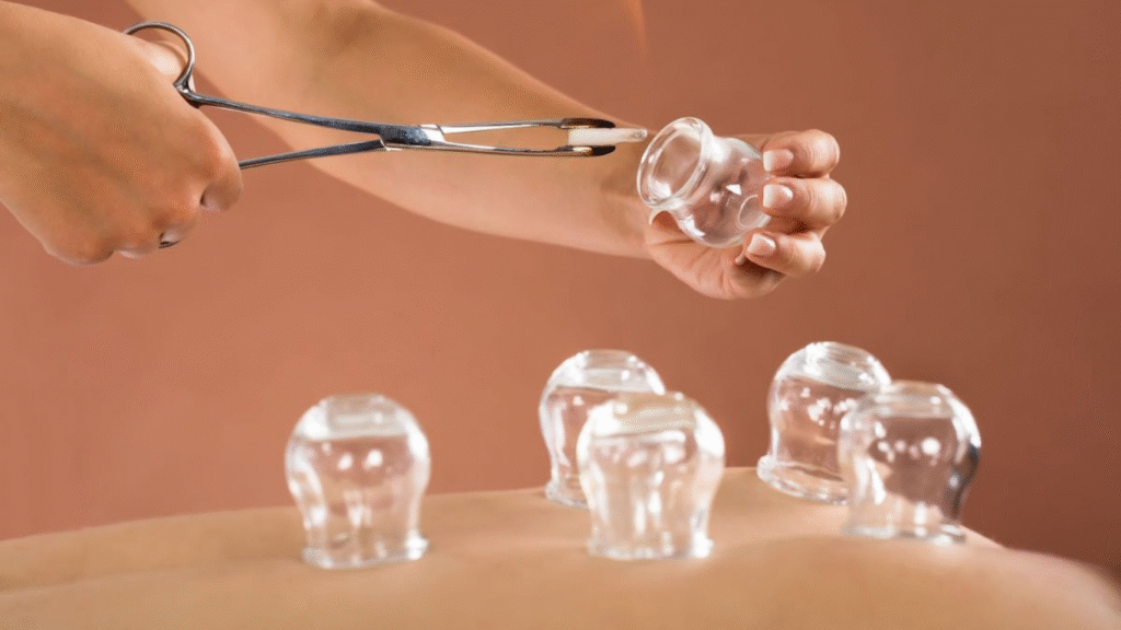 Hijama Cupping Therapy