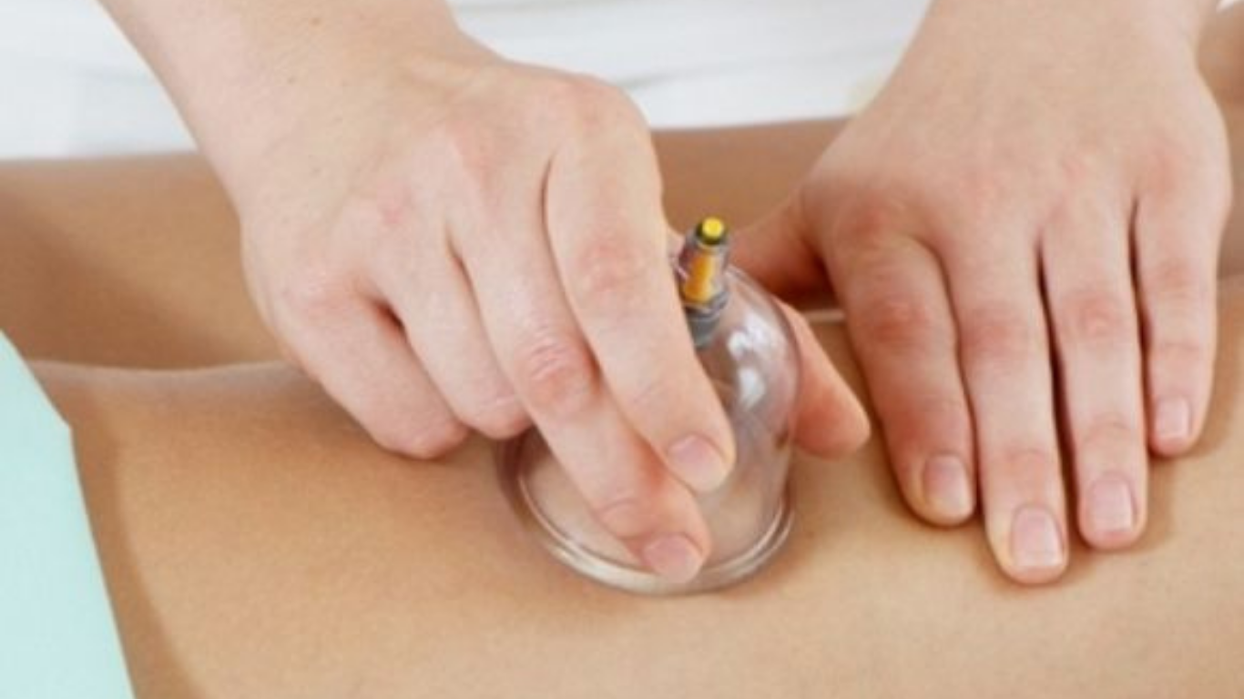 Hijama Cupping Therapy