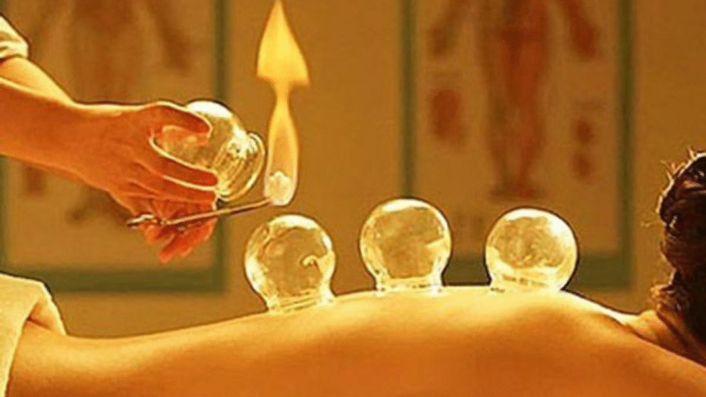 Hijama Cupping Therapy