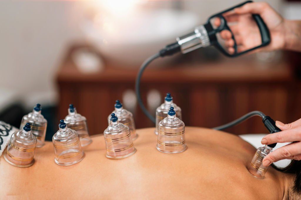 Hijama Therapy