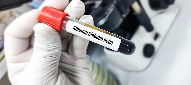 Albumin/Globulin Ratio