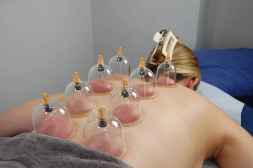 Pain Relief Cupping Dubai