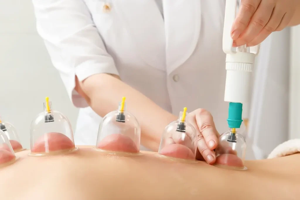 Hijama Therapy in Dubai