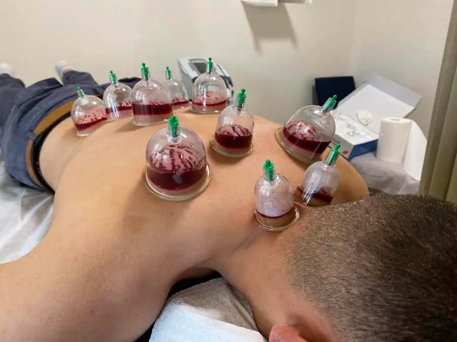Best Hijama center in Dubai
