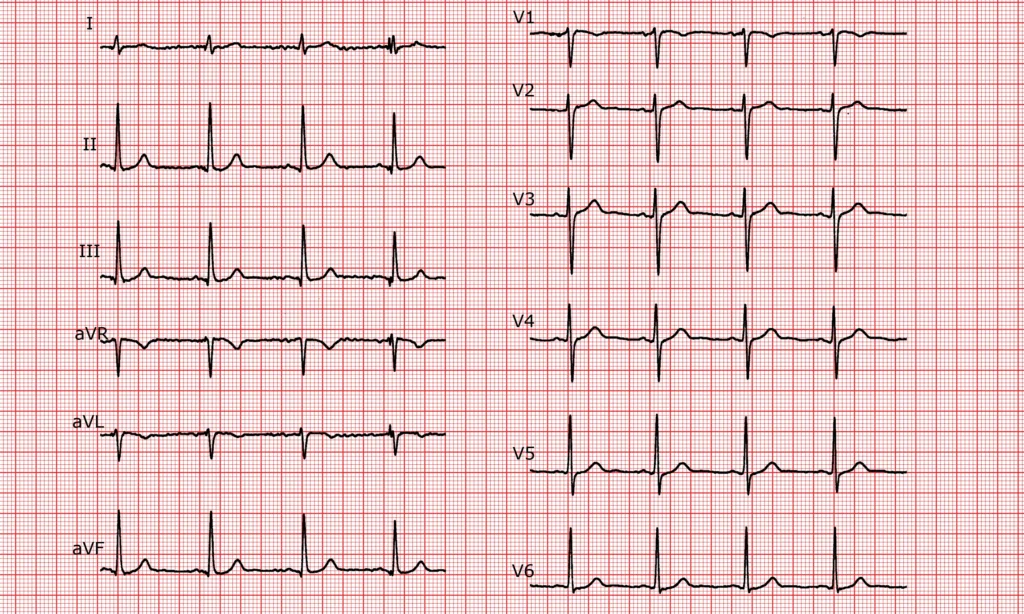 ECG in high risk populations