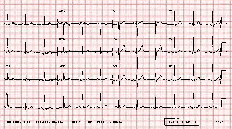 ECG in high risk populations