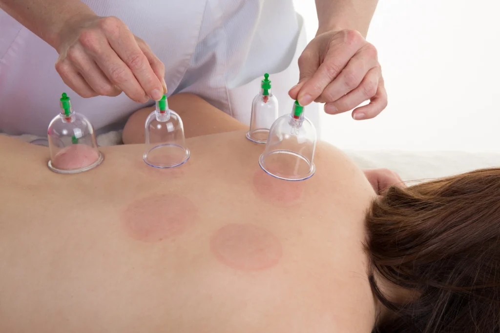 Sunnah Healing Therapy Hijama in Dubai