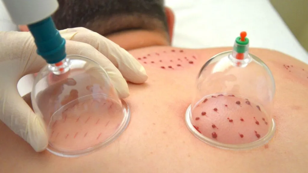Sunnah Healing Therapy Hijama in Dubai