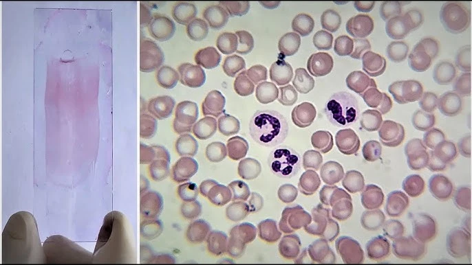 Peripheral Smear
