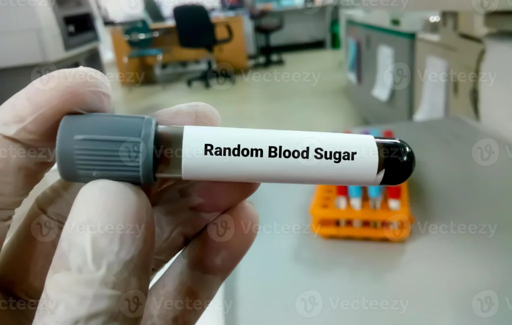 RBS (Random Blood Sugar)