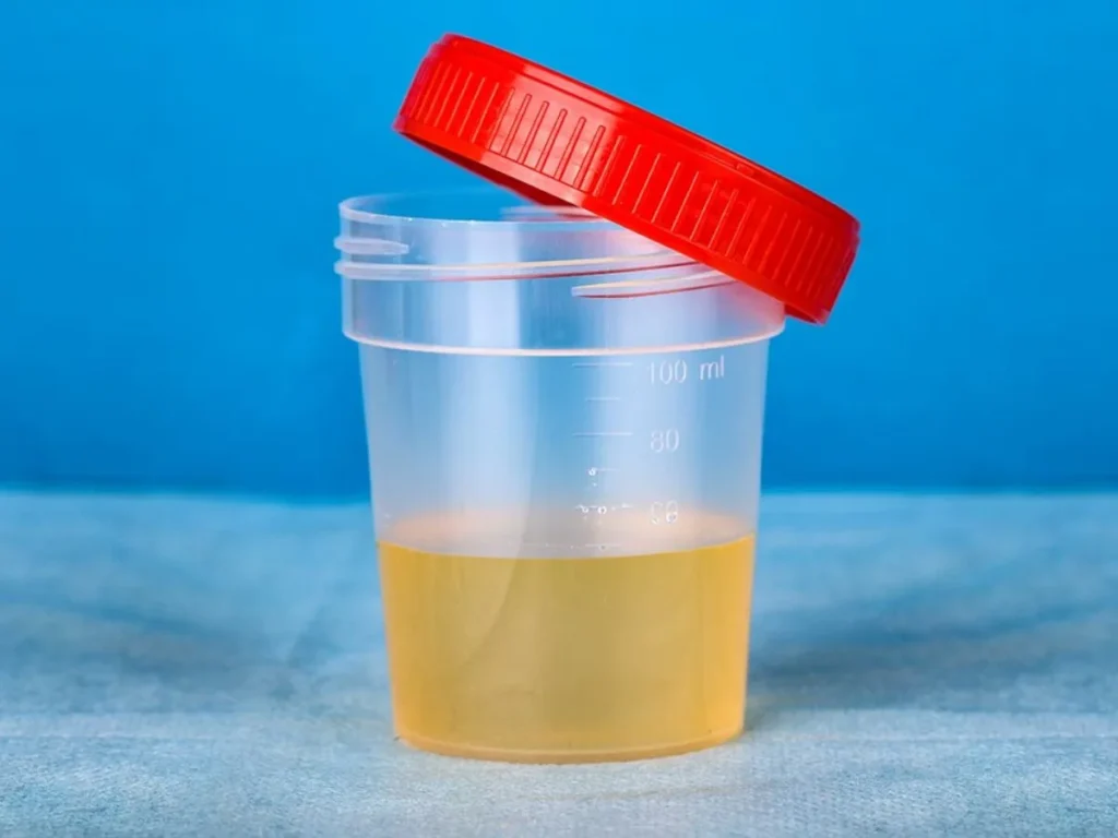 Urine Albumin