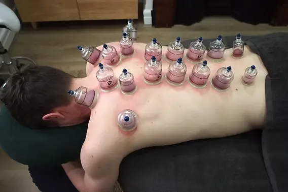 Personalized Hijama Therapy