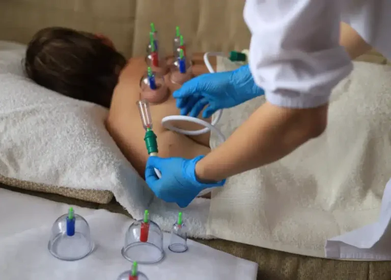 Hijama Therapy for Muscle Recovery
