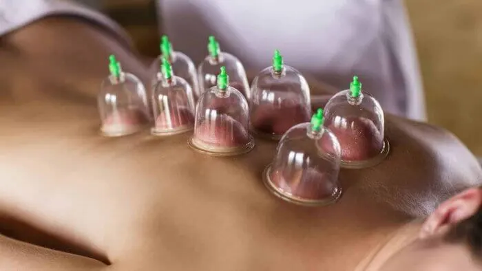 Hijama Therapy Benefits
