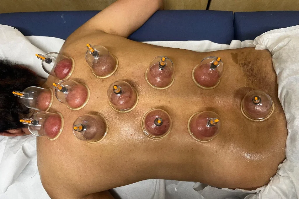 Hijama Therapy Benefits