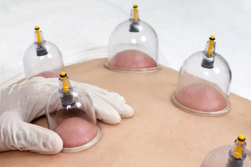 Hijama Misconceptions